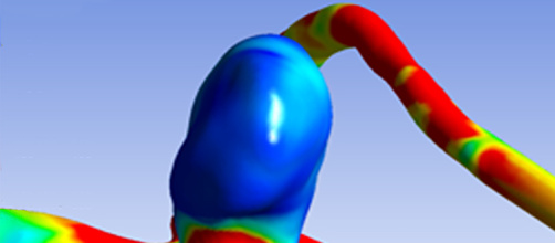 Anevrisme_cerebral_WEB.jpg